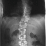 Röntgenbild-turner-syndrom-skoliose