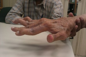 Schwanenhalsdeformität der Finger
