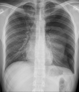 Spontanpneumothorax