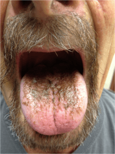 Verfärbung der Zunge unter Linezolid-Therapie