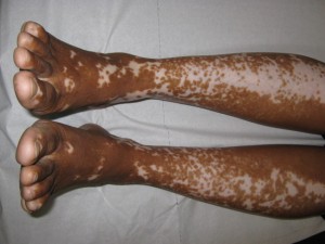 Vitiligo an den Beinen