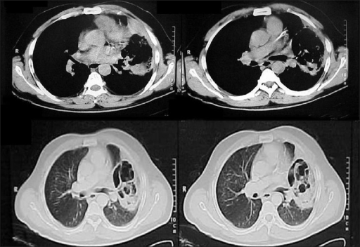 Zygomycosis der Lunge