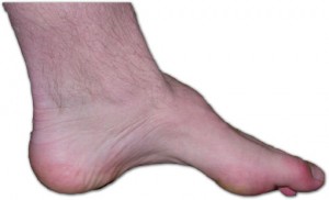atrophischer Hohlfuß bei hereditärer motosensibler Neuropathie I