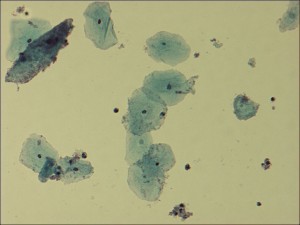 vaginale Epithelzellen besiedelt von Gardnerella vaginalis