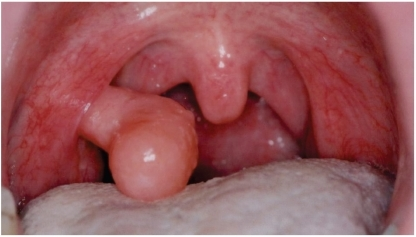 Erkrankungen Der Mundhohle Und Des Rachens Oropharynx