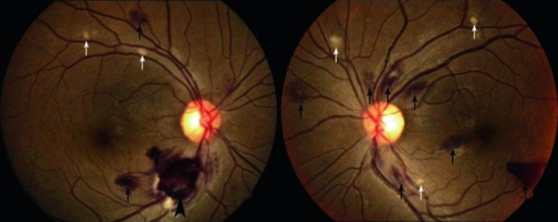 retinale Blutung