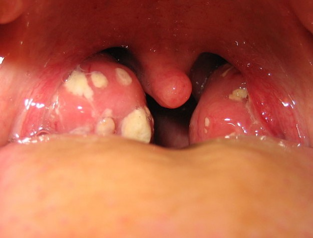 Erkrankungen Der Mundhohle Und Des Rachens Oropharynx