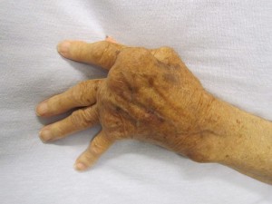 ulnare Deviation der Finger
