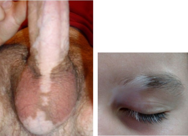 Bild Links: “Vitiligo affecting hair strand color” von culinary123. Lizenz: CC BY-SA 3.0 & Bild Rechts: “vitiligo (depigmentation) of the scrotum and penis” von Panoramalibero. Lizenz: Public Domain 