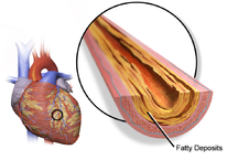 Coronary Artery Disease.