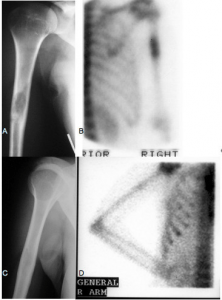 Röntgenbild der Langerhans-Zell-Histiozytose im Oberarmknochen