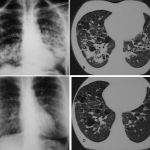 Röntgenaufnahme vom Lungenbefall durch die Langerhans-Zell-Histiozytose