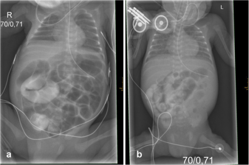 Lethal course of meconium ileus in preterm twins revealing a novel cystic fibrosis mutation 