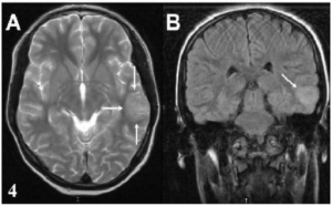 Clinical and Neuroimaging Findings of Sydenham's Chorea.