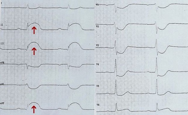 EKG eines akuten diaphragmalen Infarkts (Pfeile: ST-Hebung in II, III und aVF)