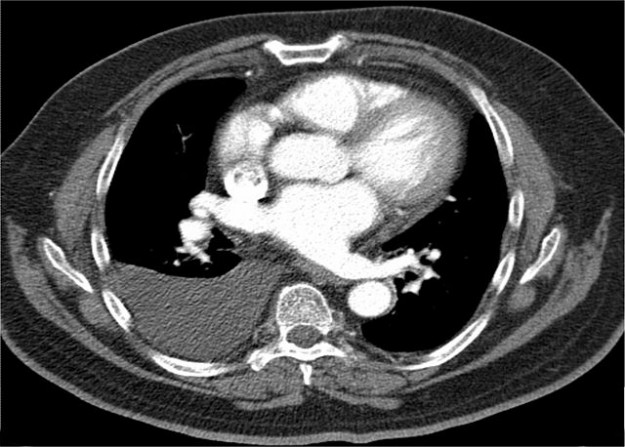 Pleuraerguss in der Computertomographie axial Weichteilfenster rechte Pleurahöhle