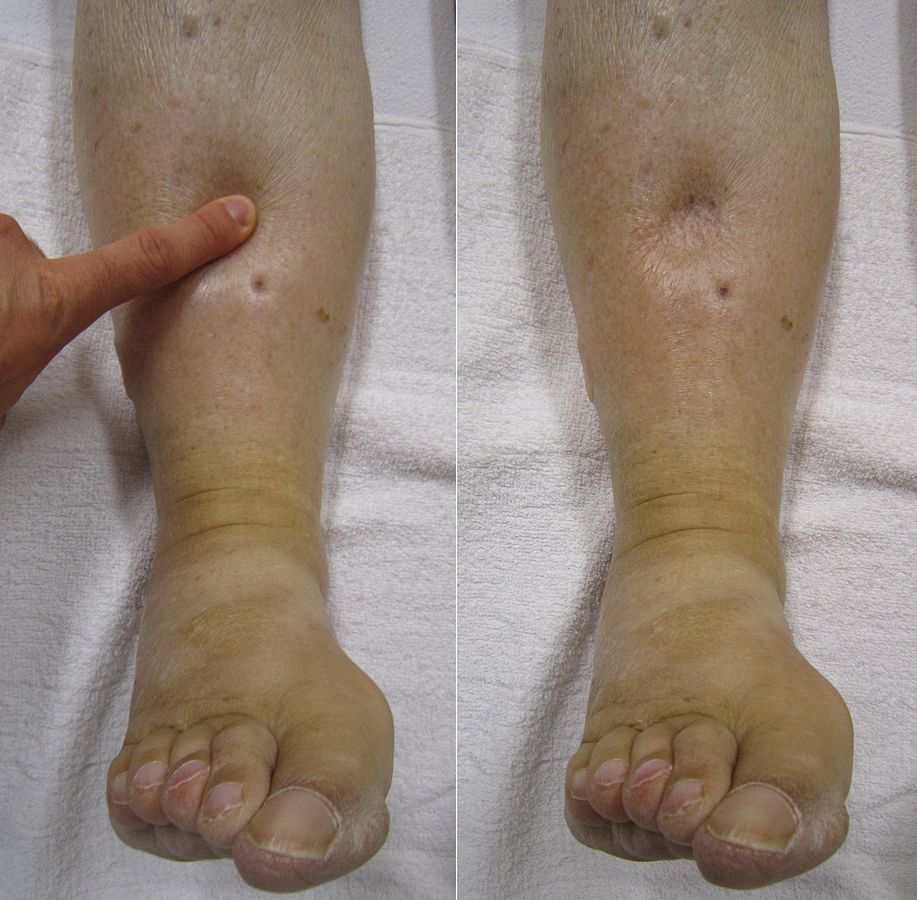 Pitting edema during and after the application of pressure to the skin.