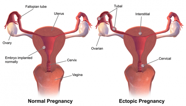 Arten der ektoptischen Schwangerschaft