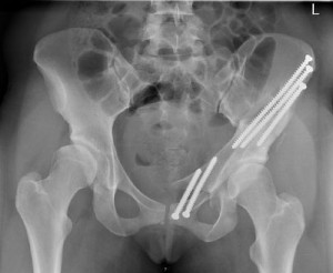 Beckenübersichts-Röntgenbild nach Dreifach-Beckenosteotomie nach Tönnis li.