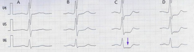 Belastungs-EKG mit ST-Senkung (Pfeil) ab 100 W (Spalte C)