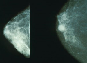 Brustkrebs im Mammogram