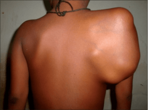 Clinical photograph showing massive scapular swelling
