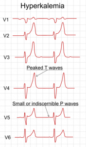 EKG bei einer Hyperkaliämie