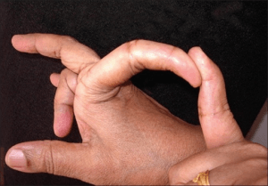 Ehlers Danlos Syndrom Finger