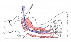 Endotracheale Intubation