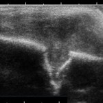 Ultraschallschnitt eines eosinophilen Granulomes am Schädel 
