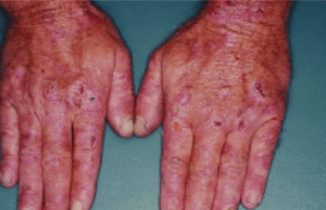 Erosions, crust, and blisters are evident on the hands of this patient with PCT