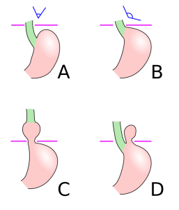 Formen der Hiatushernie: A - normale Anatomie, B - Vorstufe, C - axiale Gleithernie, D - paraösophageale Hernie