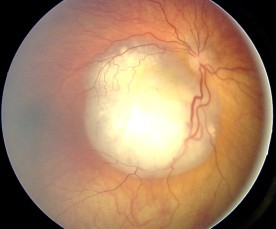 Fundus-mit-retinoblastom