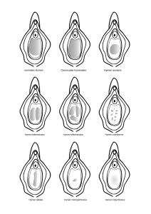 Verschiedene-Formen-des-Hymens