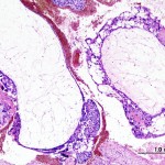 Histologisches Bild einer Blasenmole. HE-Färbung