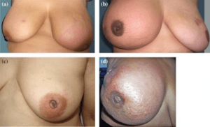 Inflammatorisches Mammakarzinom Inflammatorisches Mammakarzinom