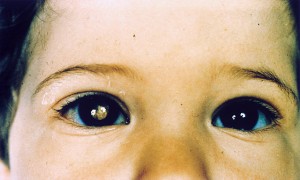 Leukokorie-Retinoblastoma-Kinderaugen