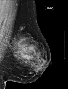 Mammogram-Ansicht