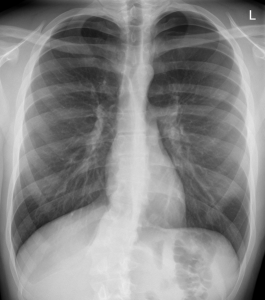Pneumothorax