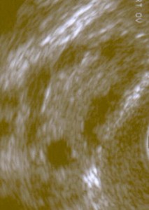 Polyzystisches Ovar im Sonogramm