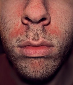 Seborrhoische Dermatitis bei einem Mann
