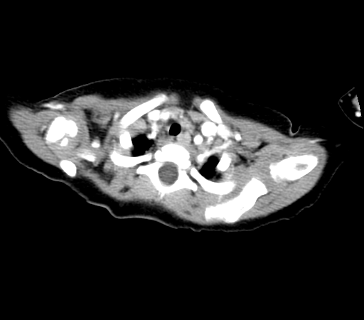 Wilms Tumor CT-Scan
