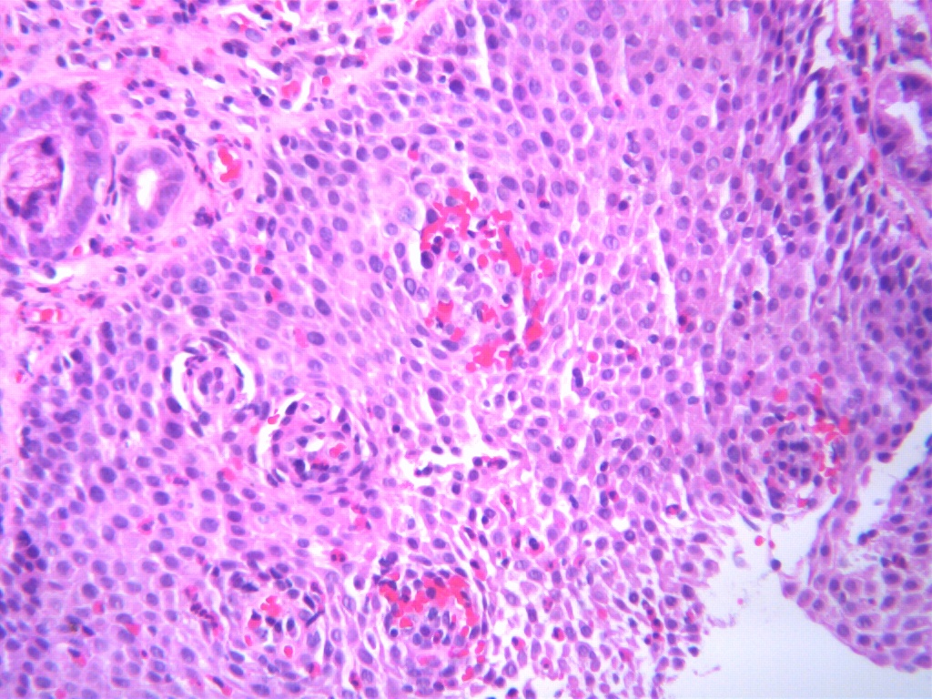 das ist eine mikrographie einer eosinophilen oesophagitis