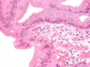 das ist eine mikrographie eines barrett oesophagus