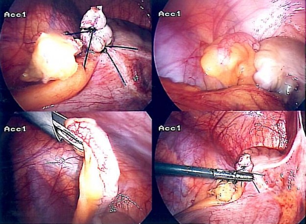 dieses bild zeigt eine laparoskopische Appendektomie