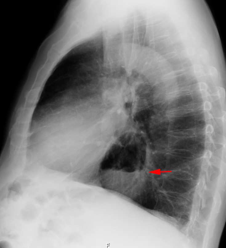 Hiatushernie im seitlichen Röntgenbild des Thorax. Pfeil auf Luft-Flüssigkeits-Spiegel.