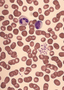 psudothrombozytopenie