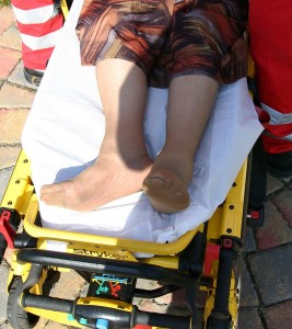 Außenrotiertes und verkürztes Bein bei Schenkelhalsfraktur rechts