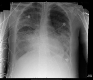 Diffuse Lungeninfiltrate im Röntgenbild