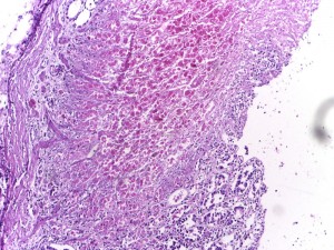 Acute stress ulcer of stomach in a postmortem specimen